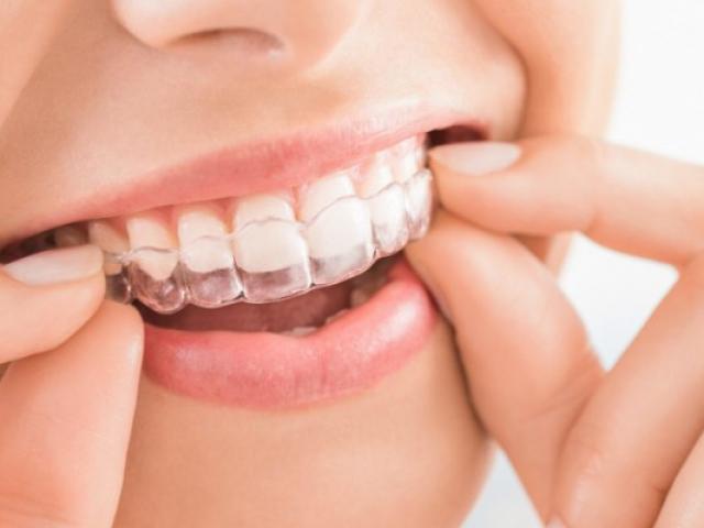 Astuces pour nettoyer vos gouttières orthodontiques (vos aligneurs) 